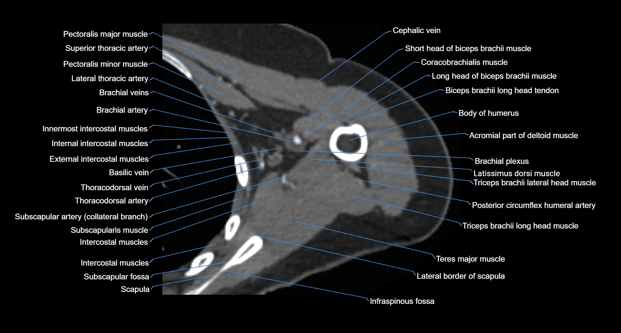 CT Shoulder axial cross sectional anatomy labelled radiology image -00055.webp